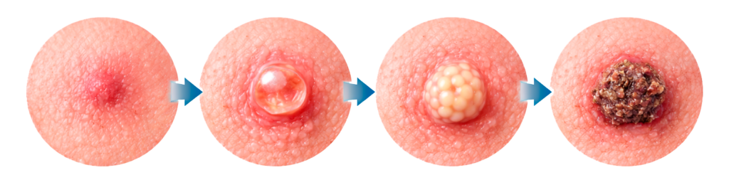 Revista Voix - Mpox: o que é, como se contrai, sintomas, prevenção, vacina e situação mundial. Evolução das lesões da Mpox na pele humana